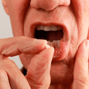 Perda de dentes