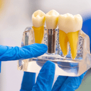 prótese dentária fixa