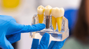 prótese dentária fixa