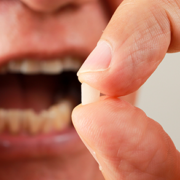 Perda de dentes