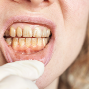 Menina com Tártaro nos dentes
