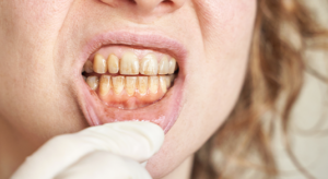 Menina com Tártaro nos dentes